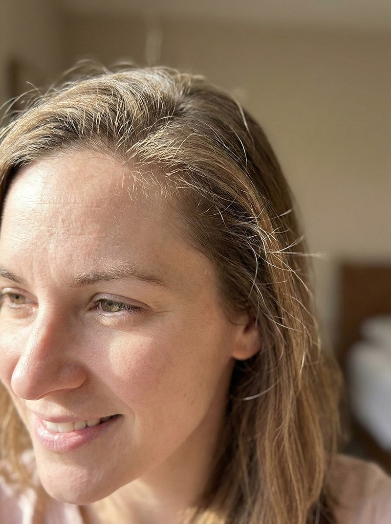 New hair regrowth and baby hairs after telogen effluvium